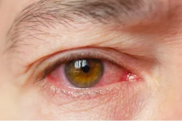 Close-up of an eye with the white strongly reddened by inflamed blood vessels.